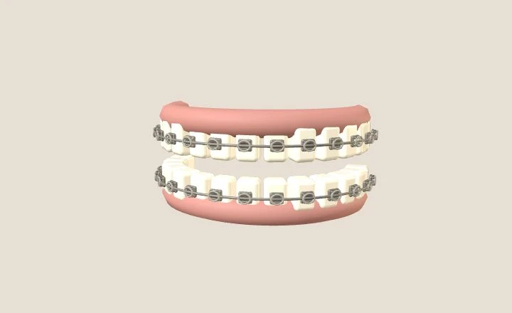 Modelo orientativo de brackets ubicados en la cara exterior de los dientes