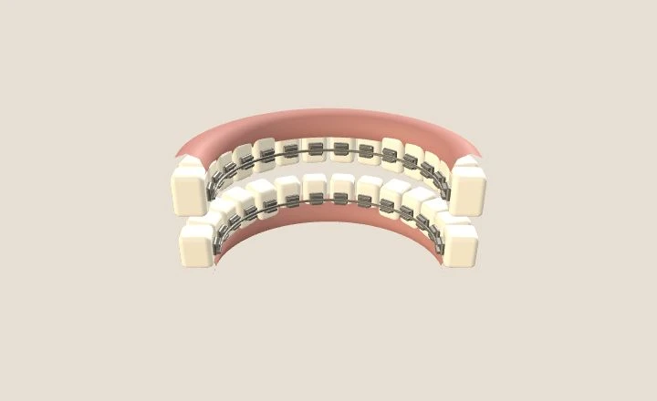 Modelo orientativo de brackets ubicados en la cara interior de los dientes